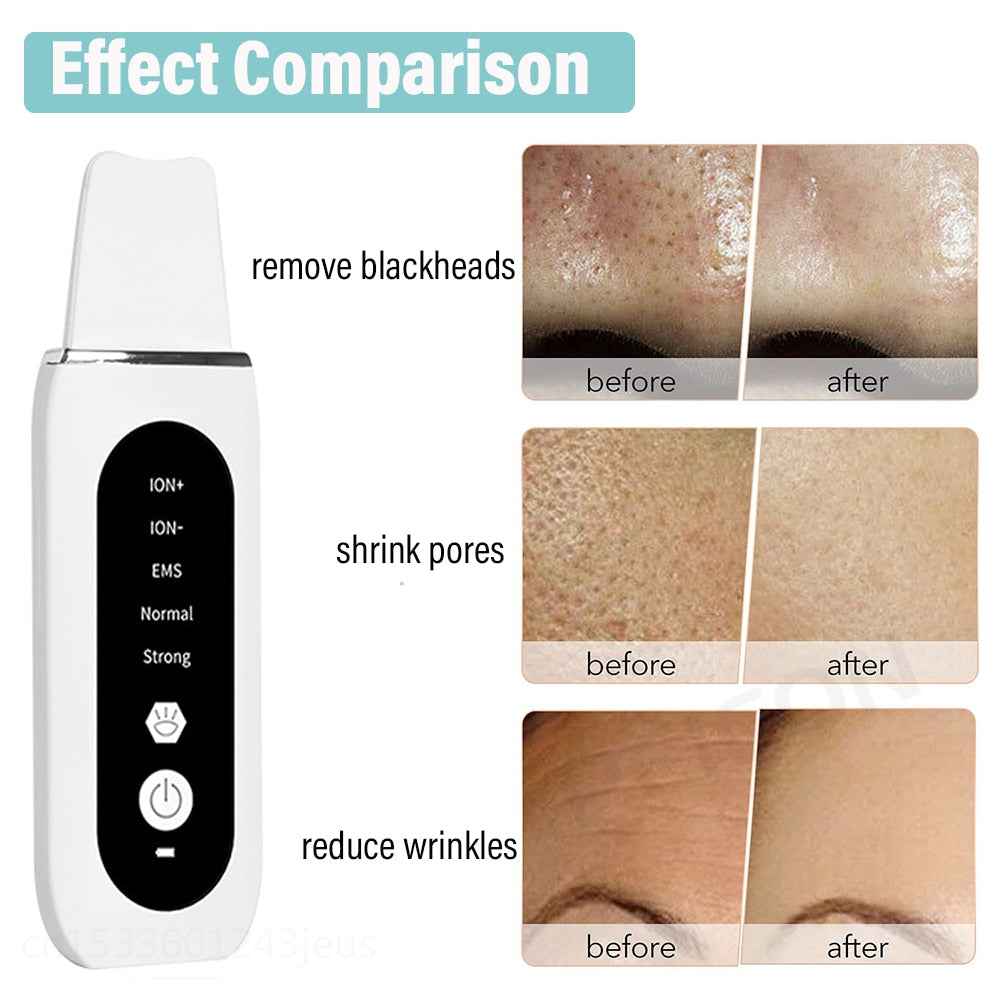 Ultrasonic Skin Scrubber Peeling Blackhead Remover